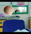 308小型准分子激光治疗仪