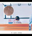 308紫外线光疗仪治疗什么